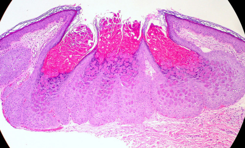 Molluscum contagiosum on the vagina