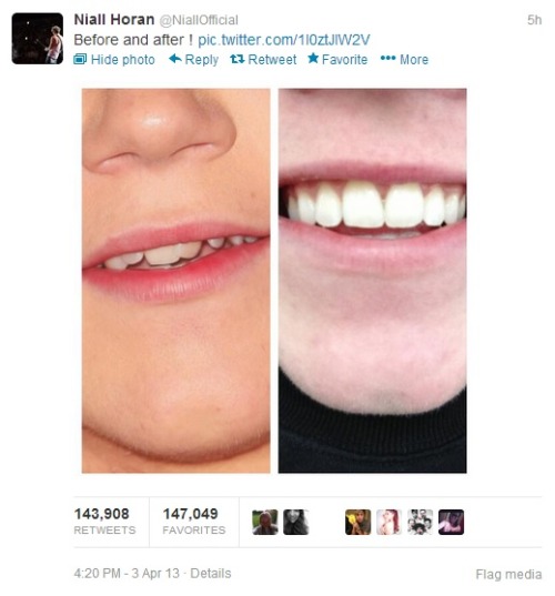 Braces before and after