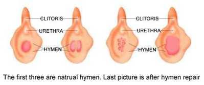 Reconstruct my hymen