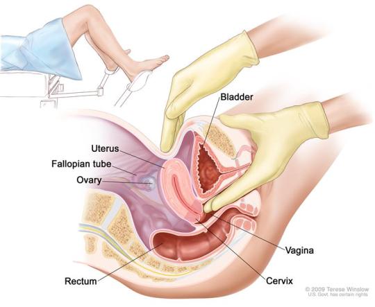 Cervical cancer stages
