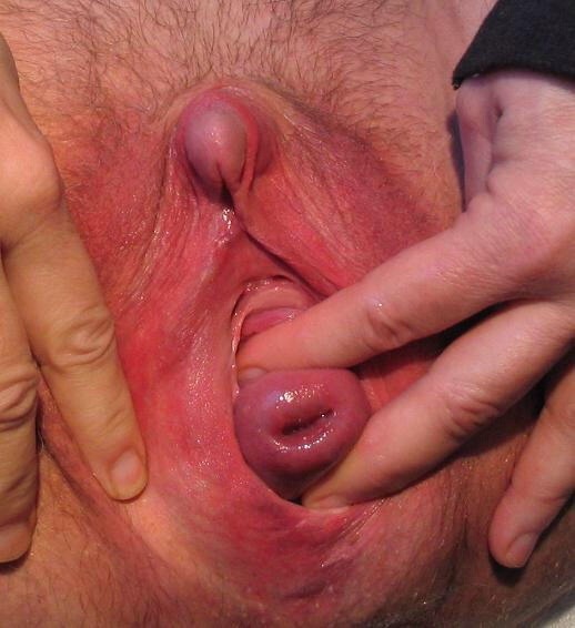 Porn cervix Cervix Prolapse
