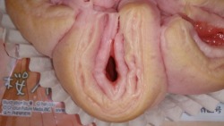 Molluscum contagiosum on the vagina