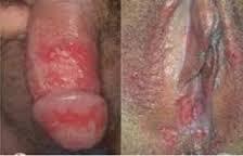 Genital herpes on penis