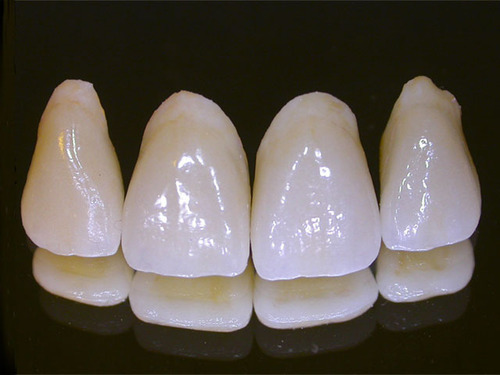 Porcelain crowns front teeth