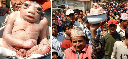 Baby born with 8 limbs in india