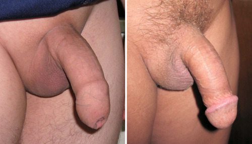 Men with tight foreskin