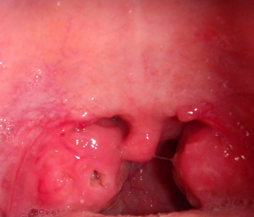 Symtoms Of Strept Throat 86