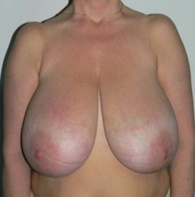 No breast reduction